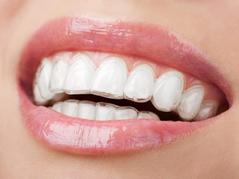 Invisalign: Kompleksowy przewodnik po nowoczesnej ortodoncji